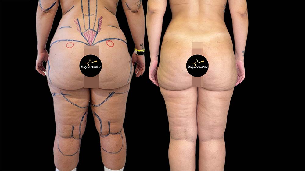 Lipedema 1(Paciente 1)