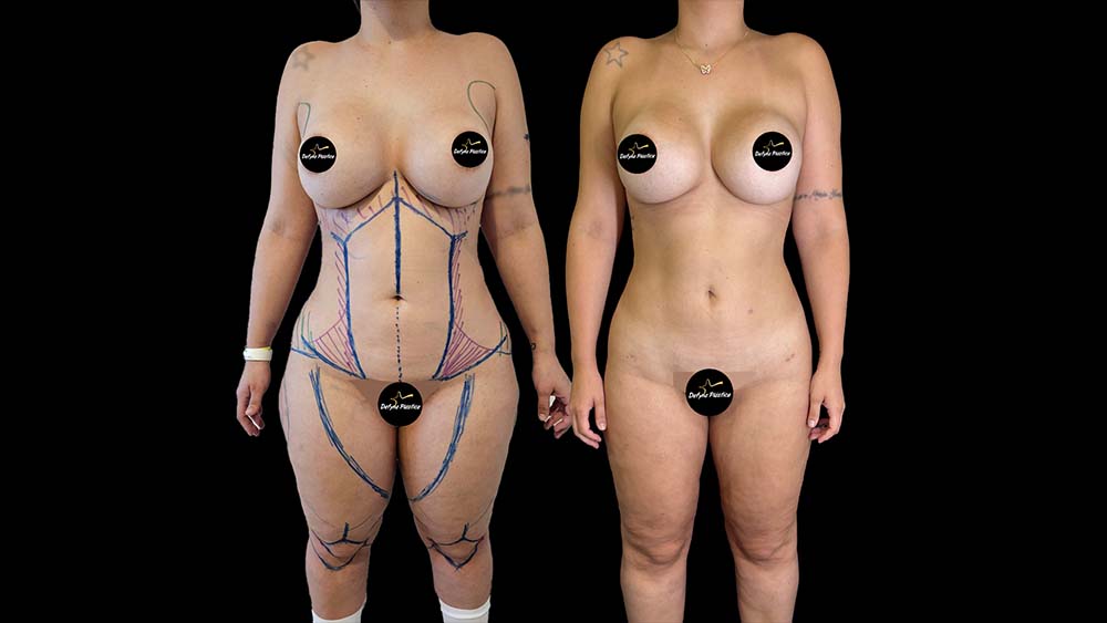 Lipedema 2(Paciente 1)