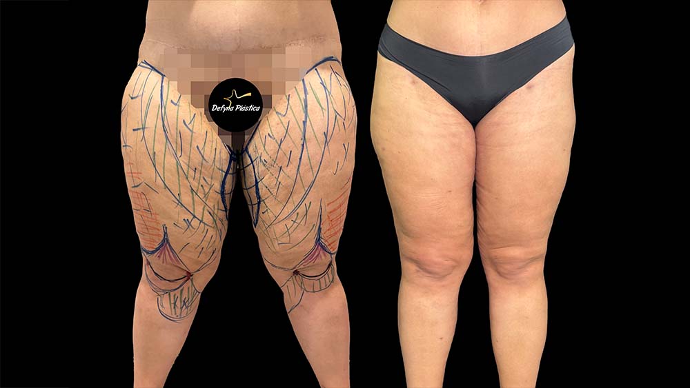 Lipedema 4(Paciente 2)