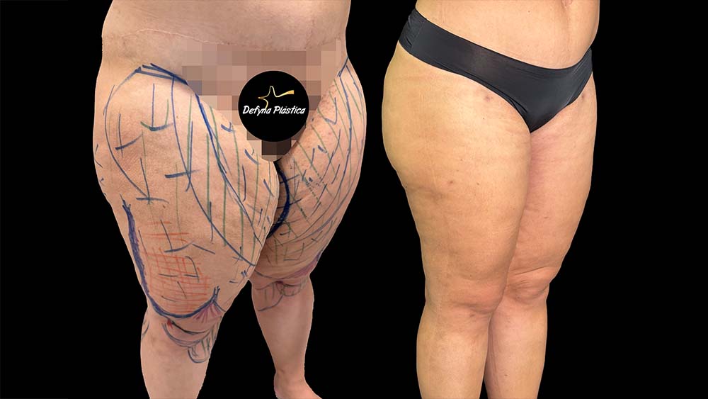 Lipedema 5(Paciente 2)