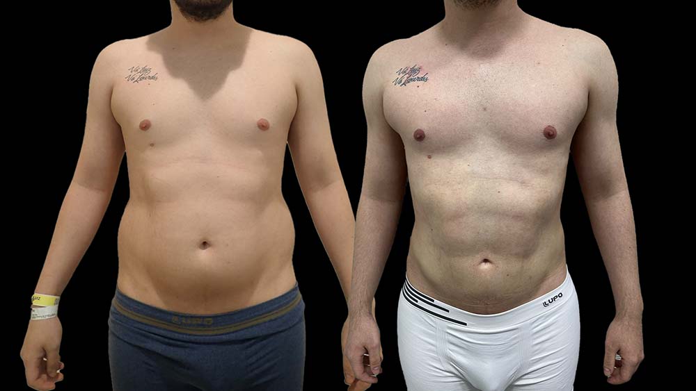 Lipo HD 1