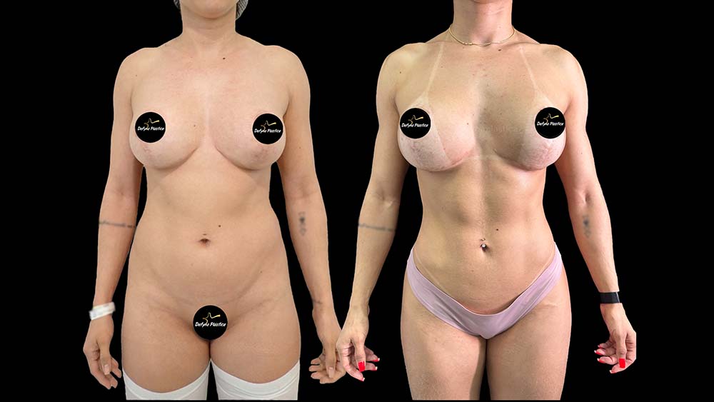 Lipo HD Ugraft