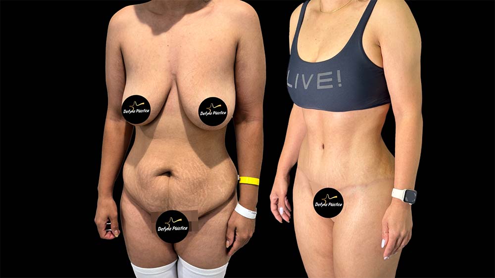 Lipoabdominoplastia HD Foto 1.2