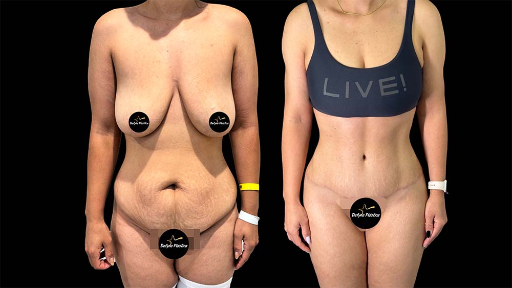 Lipoabdominoplastia HD Paciente 1.1