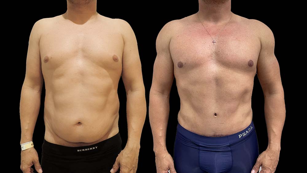Lipoabdominoplastia HD associado a Ugraft Paciente 3