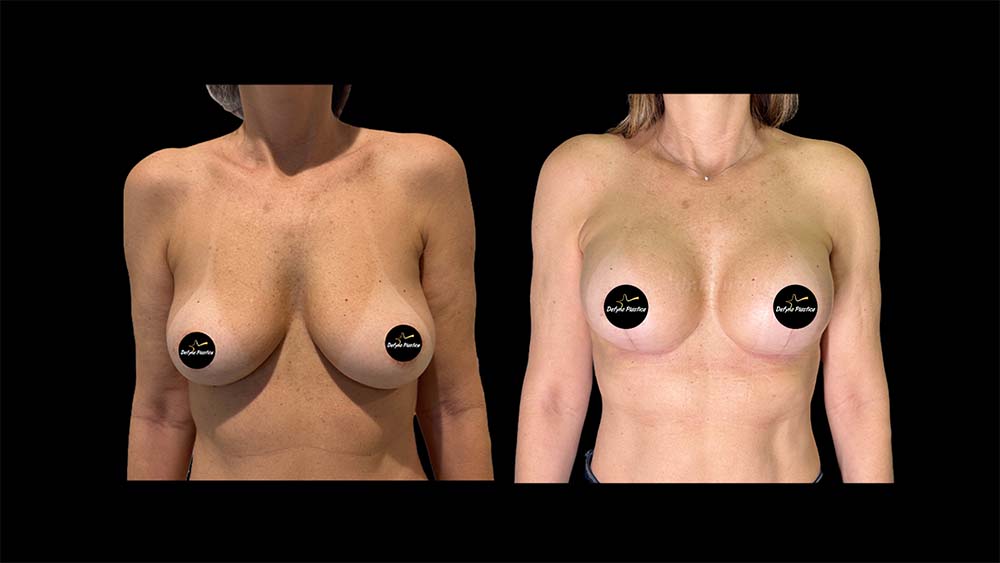 Mamoplastia Com Prótese 1