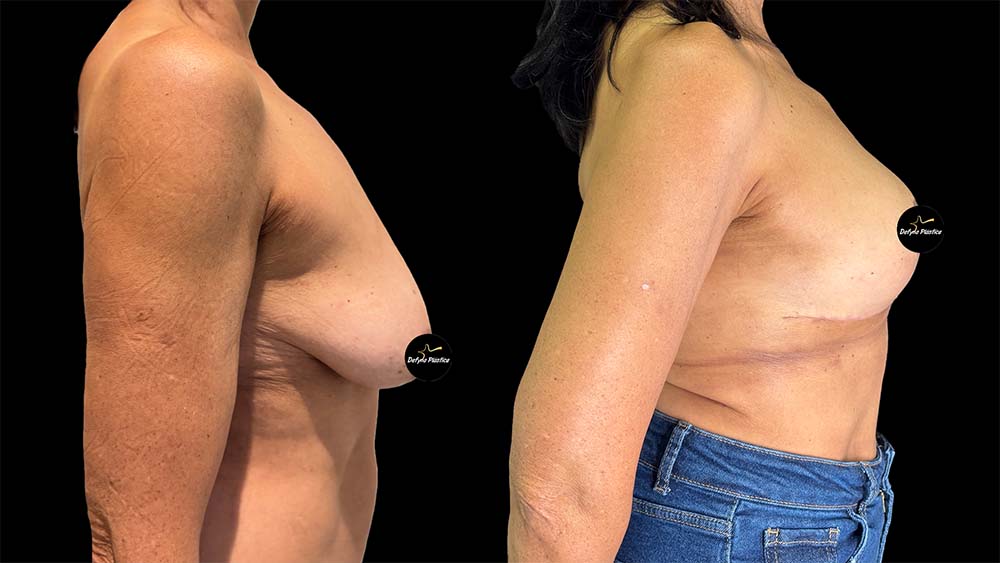 Mamoplastia Sem Prótese 1