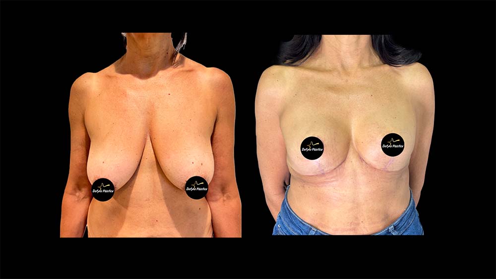 Mamoplastia Sem Prótese 2