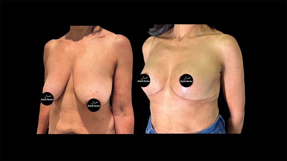 Mamoplastia Sem Prótese 3