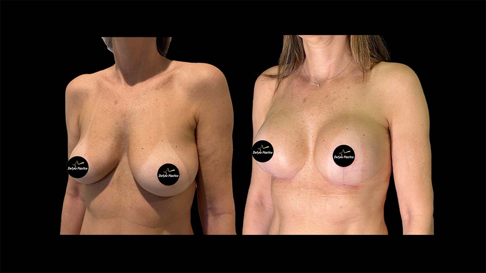 Mamoplastia com Prótese 2